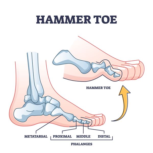 hammer toe