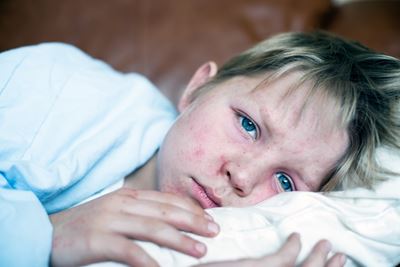 Kid with measles