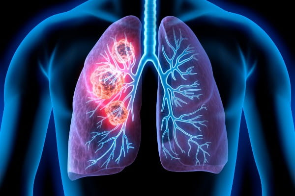 graphic of lungs