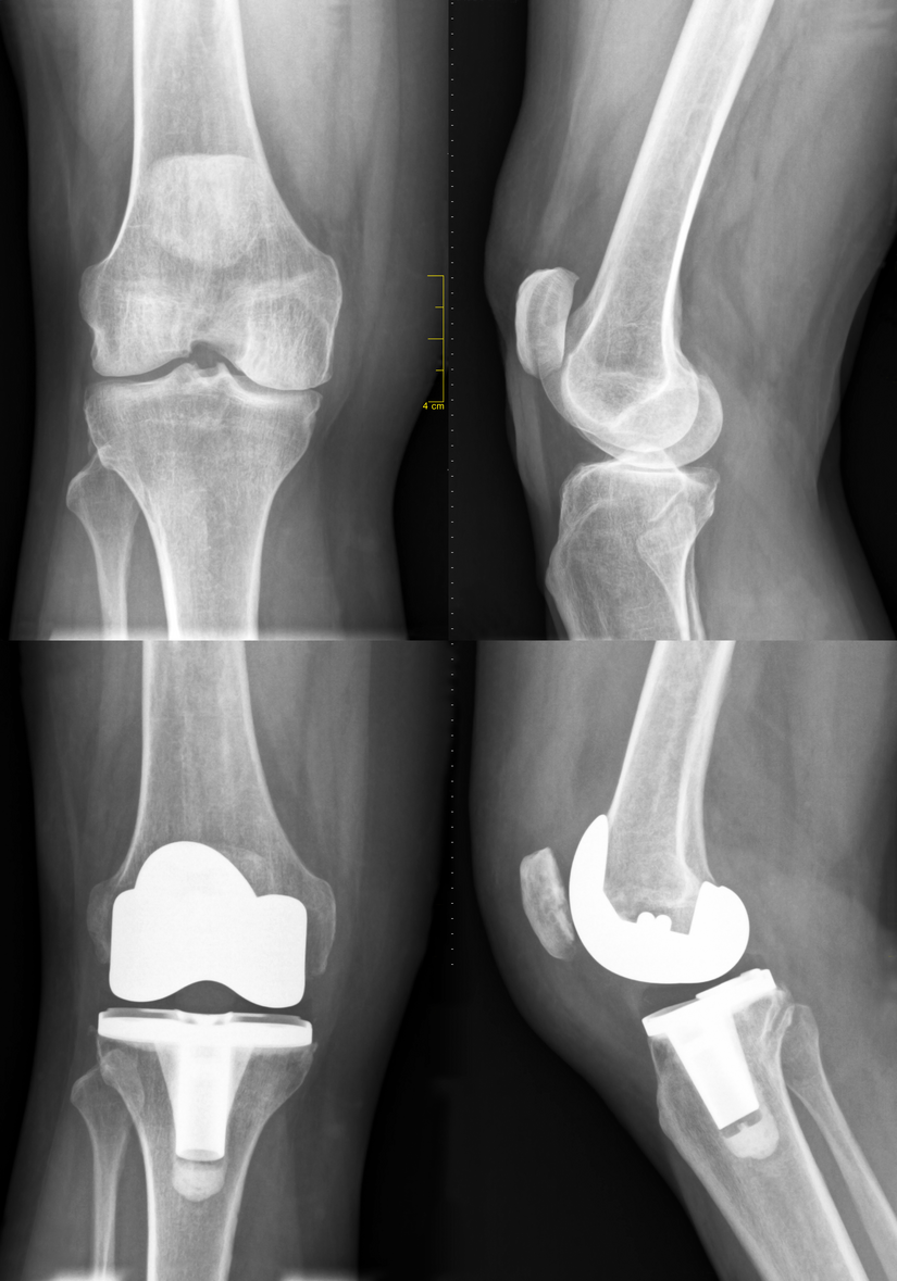 Knee X-ray image before and after a total knee replacement operation. The diseased knee joint (damaged cartilage) is replaced with artificial material (White parts = prosthesis). Frontal view and side-view.