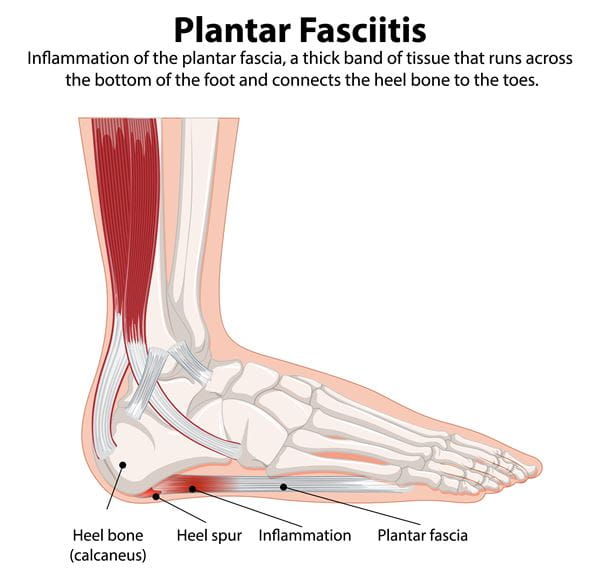 plantar fasciitis