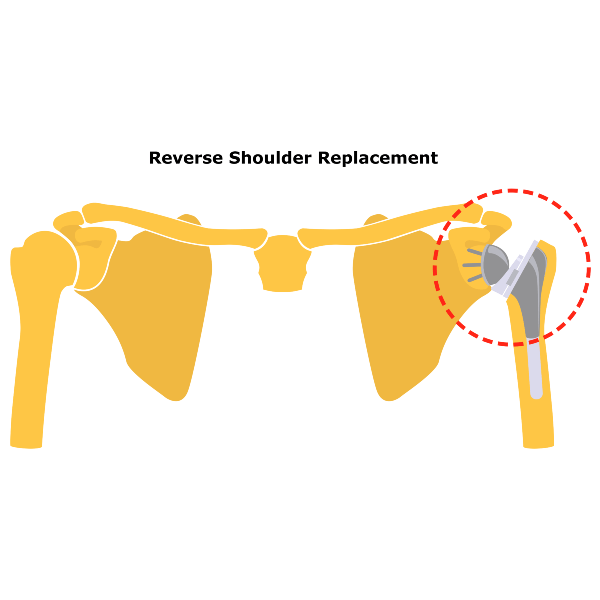 Rotator Cuff Blog Reverse Shoulder Replacement