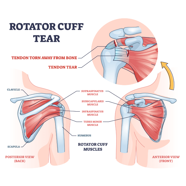 Rotator Cuff Blog shoulder muscle trauma