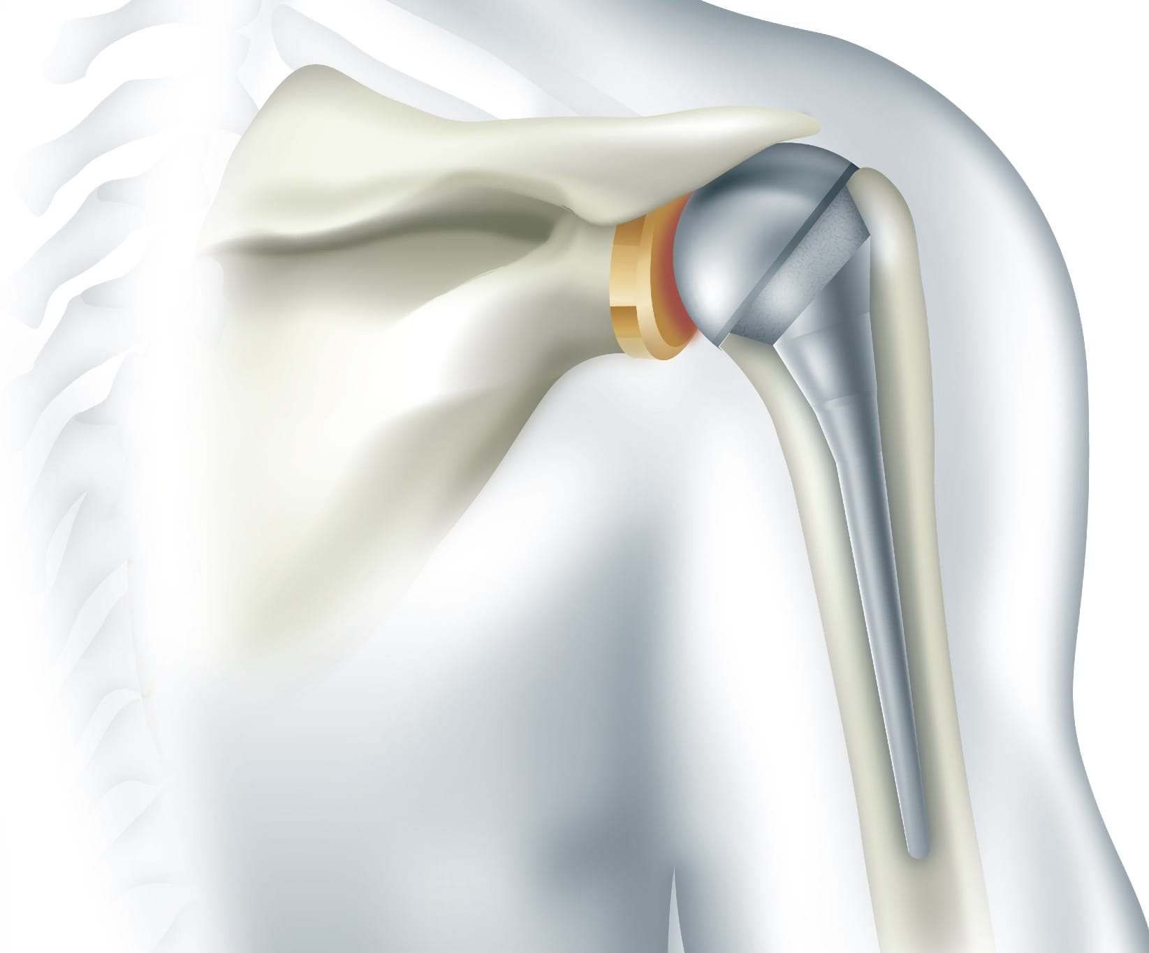 Rotator Cuff Blog Shoulder Replacement