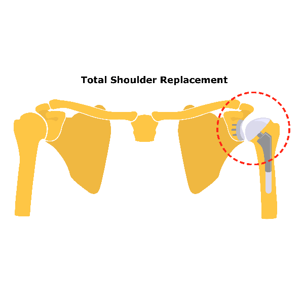 Rotator Cuff Blog Total Shoulder Replacement