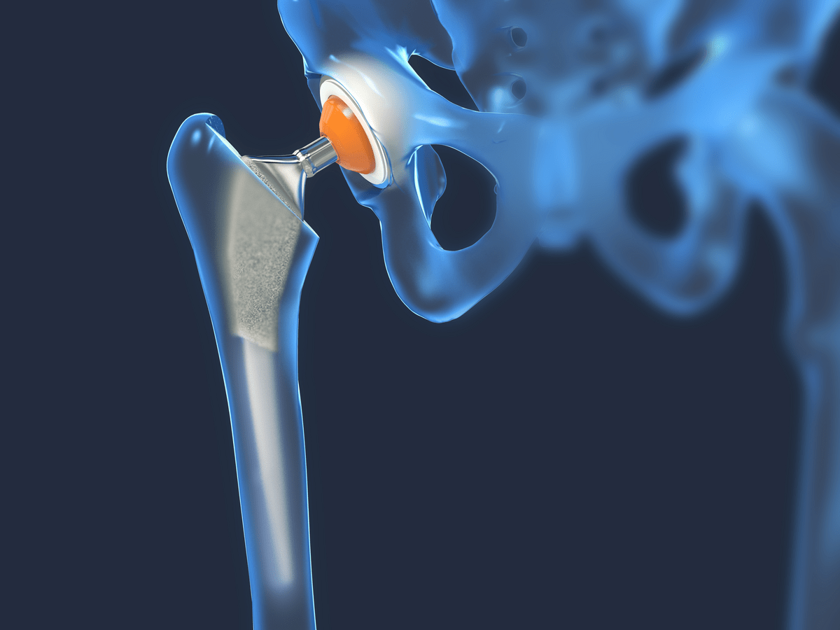 Function of a hip replacement surgery is in frontal view -