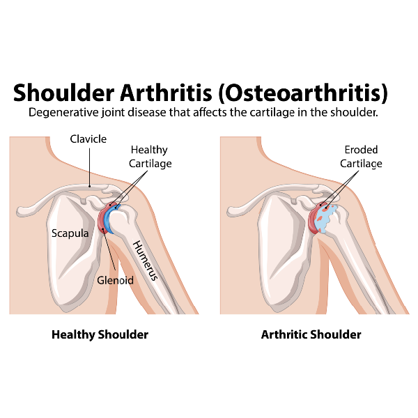 Shoulder and Upper Arm Pain blog shoulder joint diagram