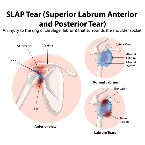 Shoulder and Upper Arm Pain Blog SLAP Tear