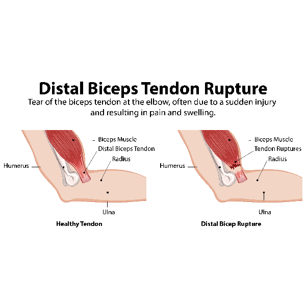 Shoulder and Uppper Arm Pain Blog biceps tendo