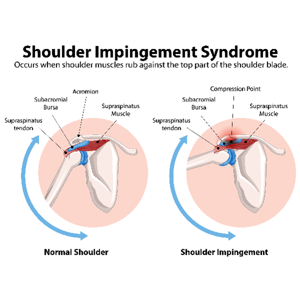 Shoulder and Uppper Arm Pain Blog impingement Syndrome