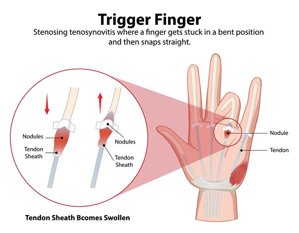 trigger finger