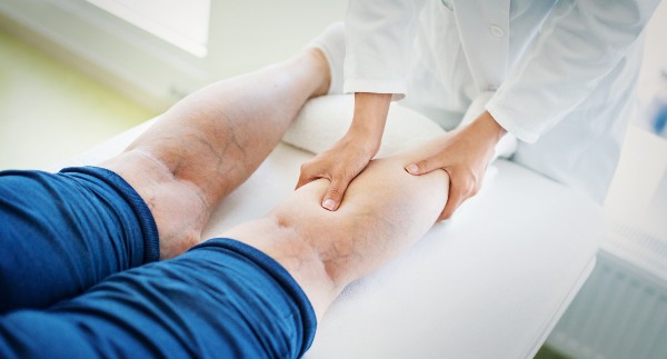varicose veins