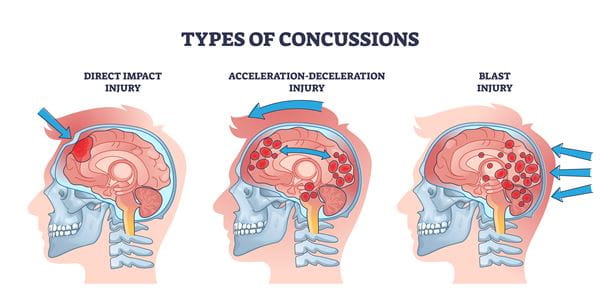 Types of Concussion